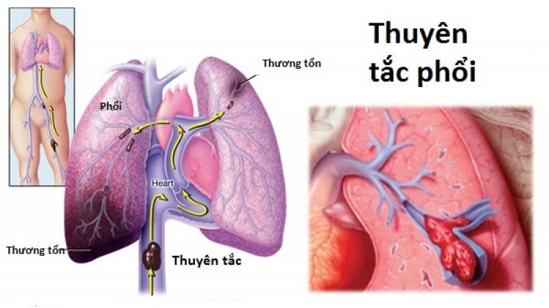 Thuyên tắc phổi