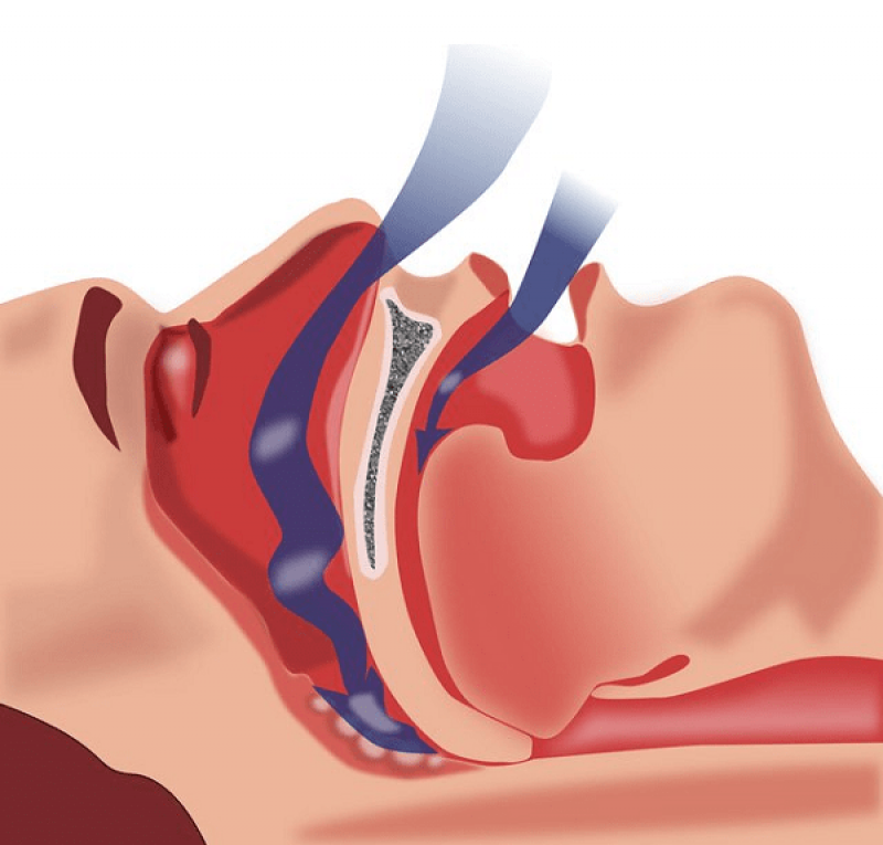 Tiết lộ bí quyết điều trị chứng ngưng thở khi ngủ