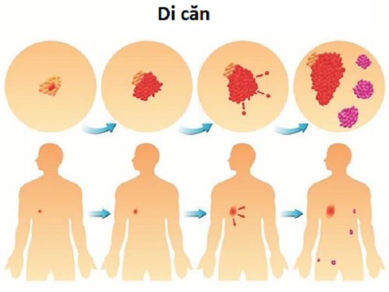 Tìm hiểu cơ chế di căn của ung thư và cách nhận diện Tìm hiểu cơ chế di căn của ung thư và cách nhận diện