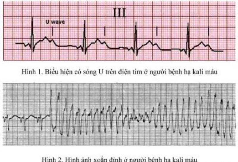 Hạ Kali trong máu là biểu hiện của bệnh gì?