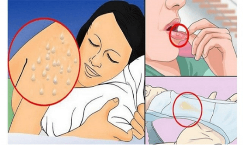 Tổng hợp những triệu chứng bệnh HIV thường gặp ở nữ giới