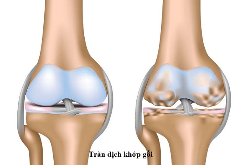 Tràn dịch khớp gối Tràn dịch khớp gối