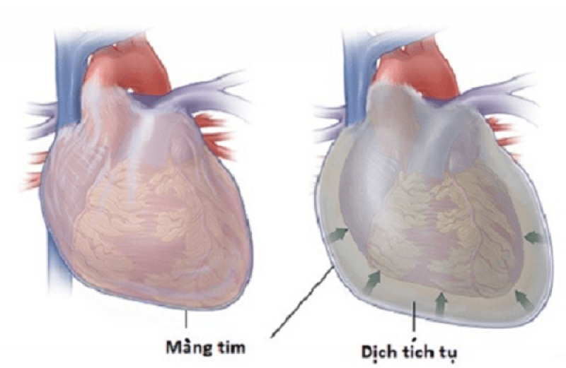 Tràn dịch màng tim
