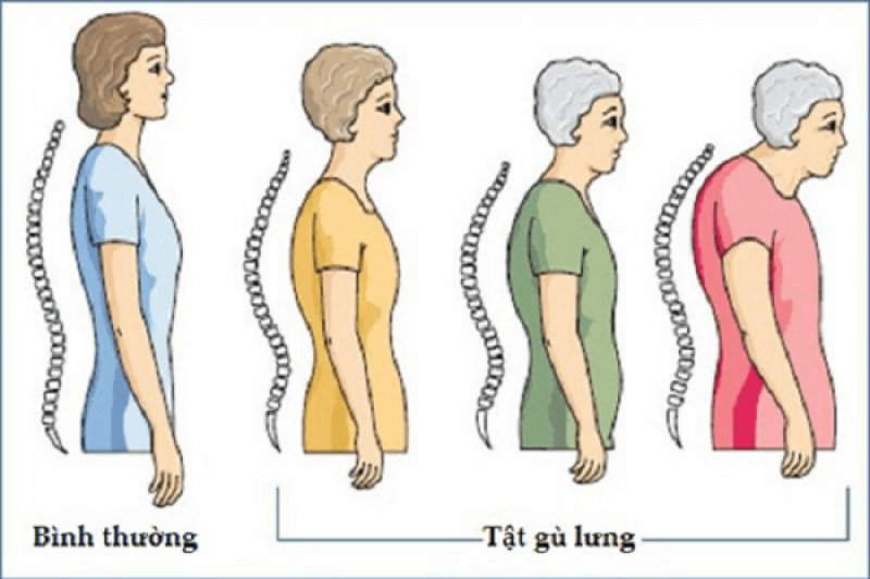 Triệu chứng, dấu hiệu, biến chứng bệnh gãy xẹp lún đốt sống