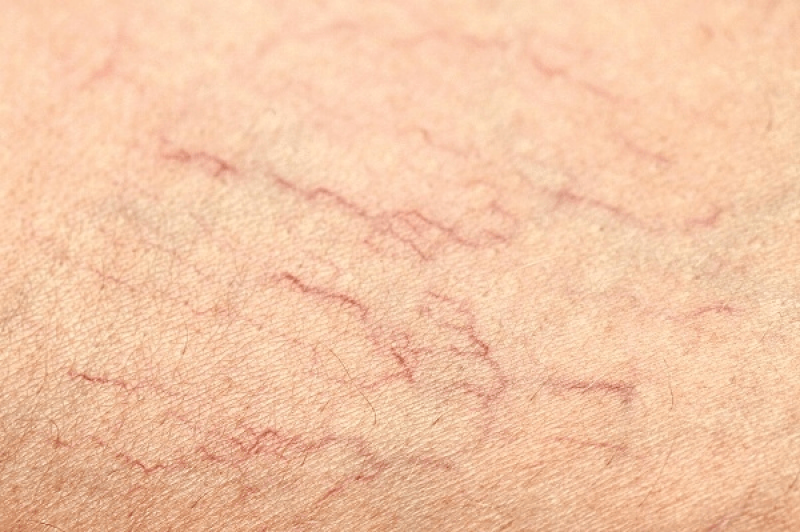 Triệu chứng giãn tĩnh mạch, nguyên nhân và cách chữa trị
