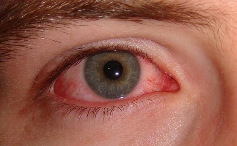 Triệu chứng mắt đỏ - nguyên nhân và cách chữa trị