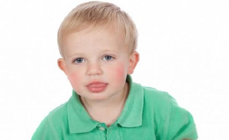 Triệu chứng nói ngọng ở trẻ em và cách khắc phục