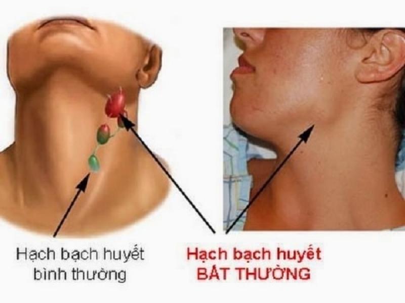 Triệu chứng sưng hạch, nguyên nhân và cách điều trị