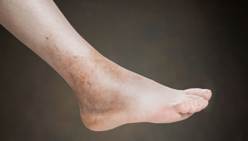Triệu chứng sưng mắt cá chân là biểu hiện của bệnh gì