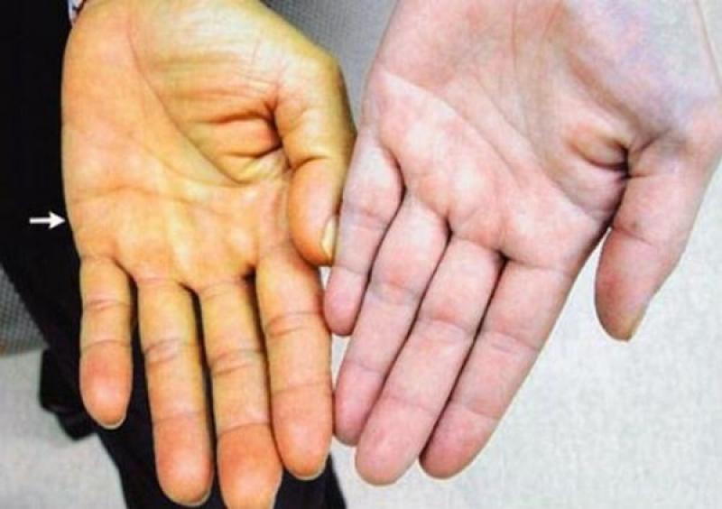 Triệu chứng vàng da là dấu hiệu của những bệnh gì?