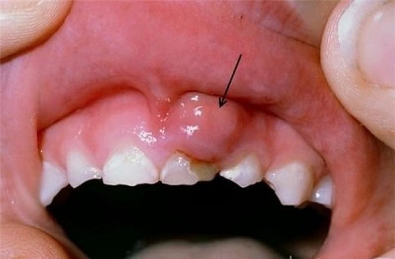 U lợi - u nướu U lợi - u nướu