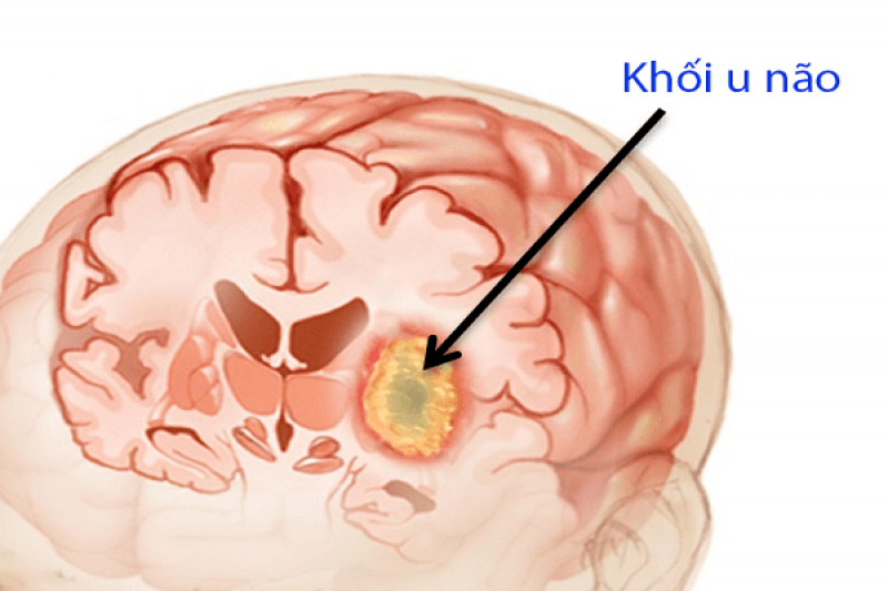 U não - Brain tumor