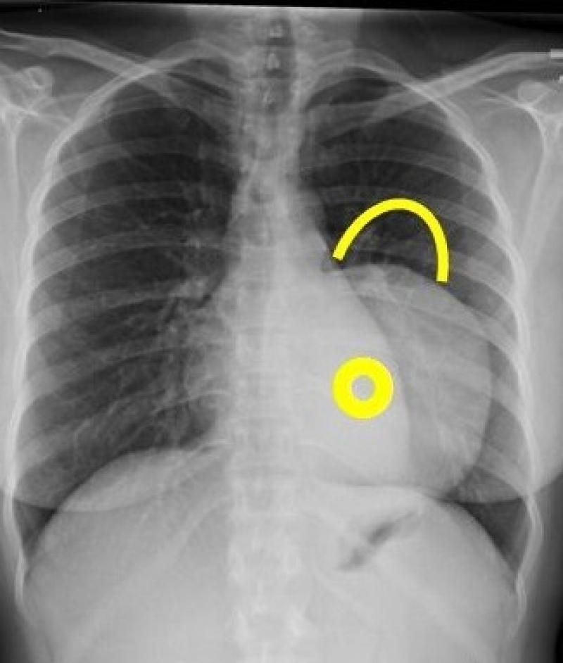 Cách xử lý hạch u trung thất lớn giai đoạn cuối