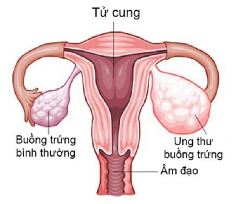 Ung thư buồng trứng Ung thư buồng trứng