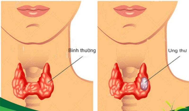 Ung thư tuyến giáp