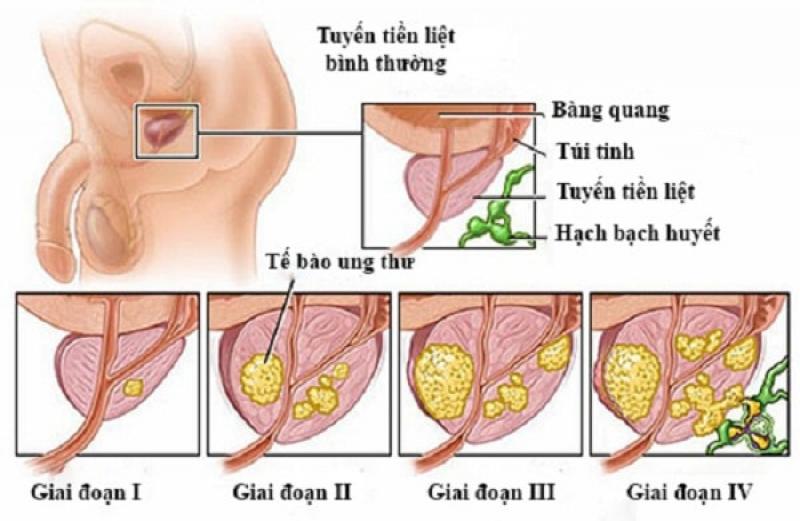 Ung thư tuyến tiền liệt
