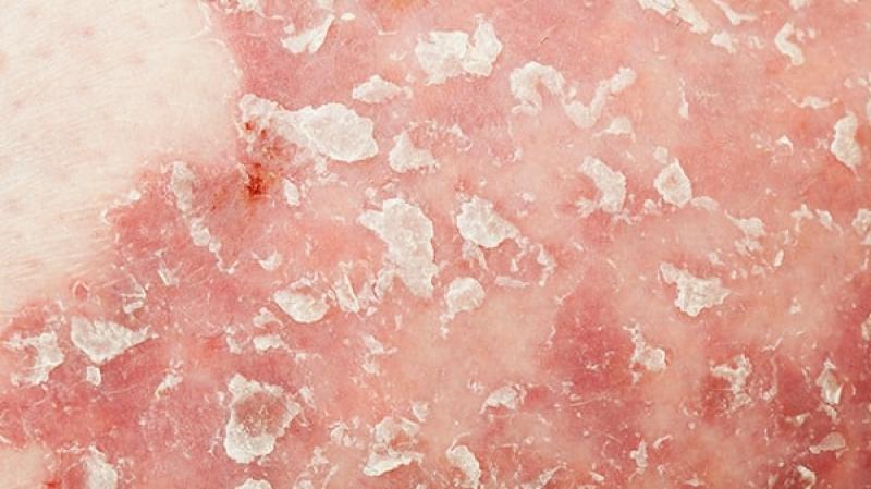 Vảy nến Psoriasis