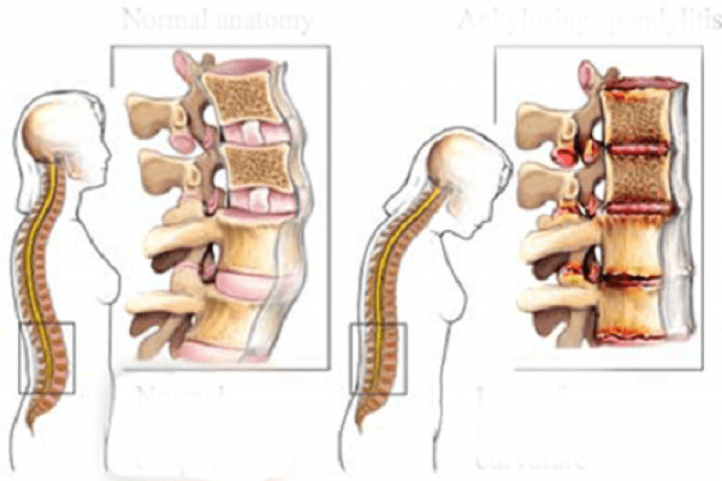 Viêm cột sống dính khớp 