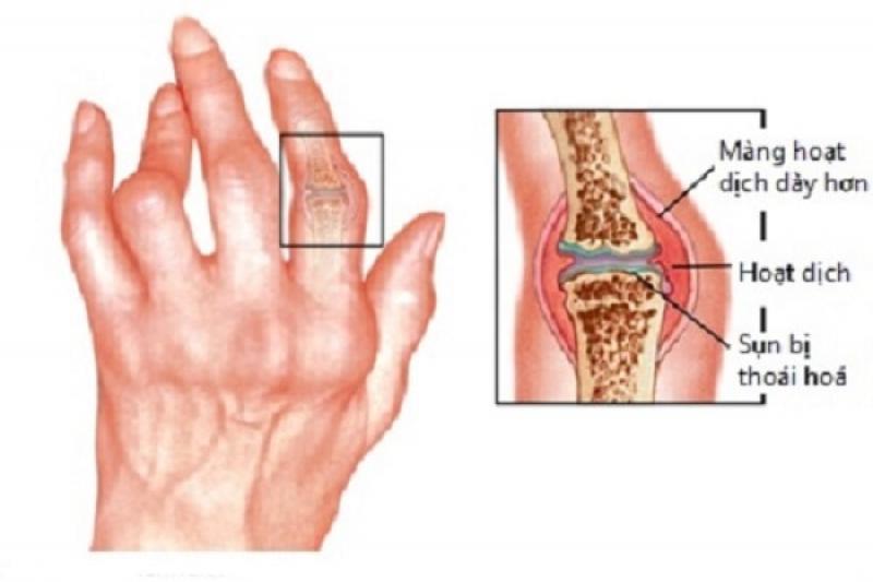 Viêm khớp dạng thấp