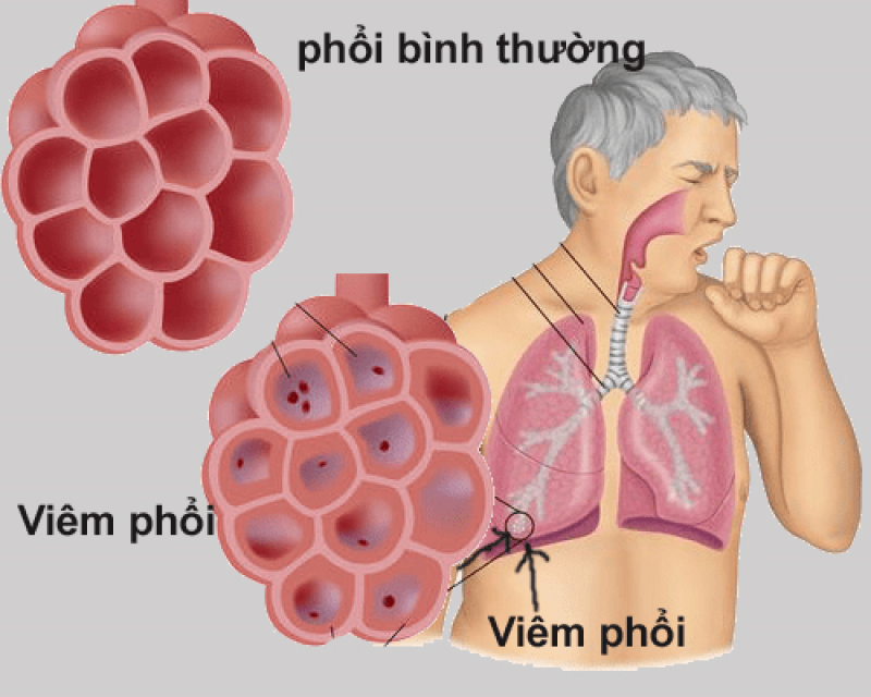 Viêm phổi