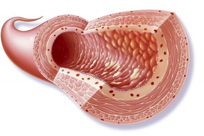 Viêm ruột Crohn