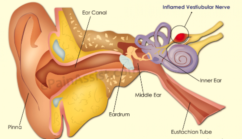 Viêm thần kinh số 8