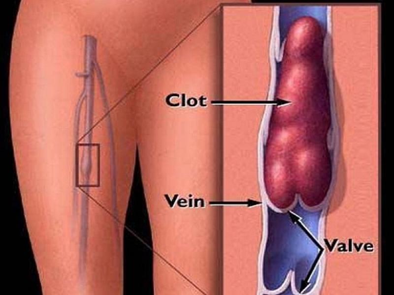 Viêm tĩnh mạch huyết khối