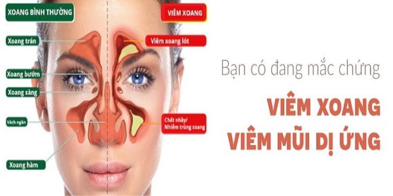 Viêm xoang