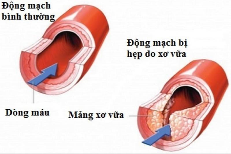 Xơ vữa động mạch Xơ vữa động mạch