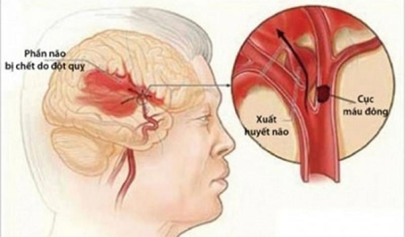 Xuất huyết não Xuất huyết não