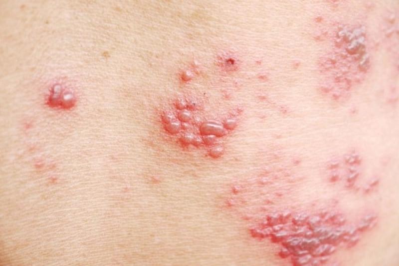 Zona thần kinh - Shingles