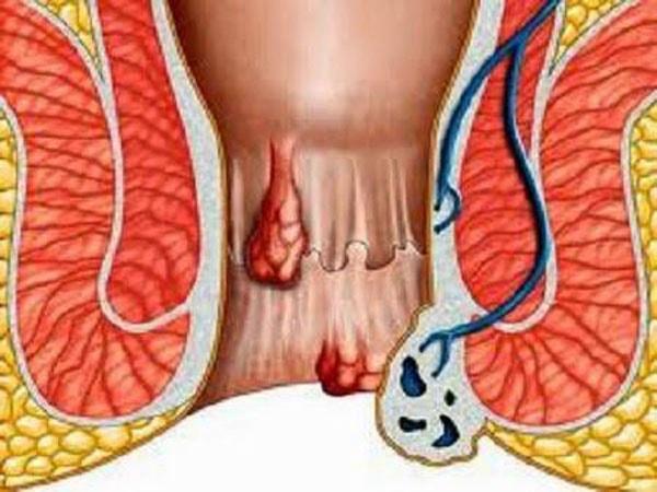 Chảy máu trực tràng là dấu hiệu của bệnh gì?