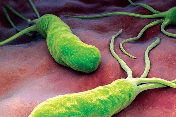 Dấu hiệu, triệu chứng bệnh nhiễm khuẩn Helicobacter pylori HP