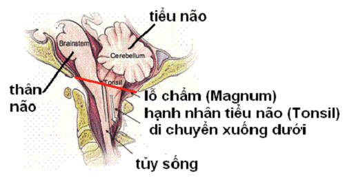 Dị dạng Chiari