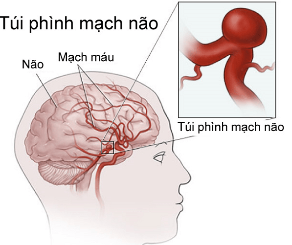 Dị dạng động tĩnh mạch