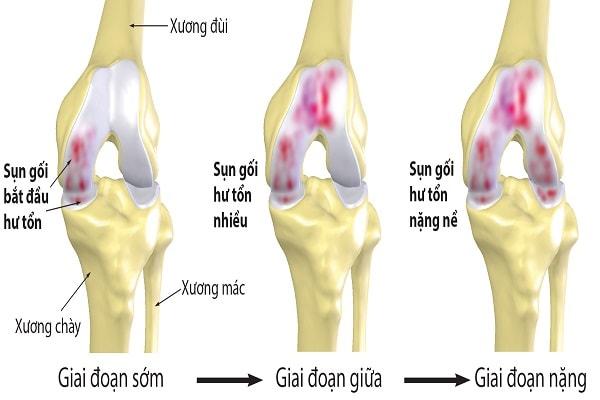 Các cách điều trị chữa bệnh thoái hóa khớp gối hiện nay