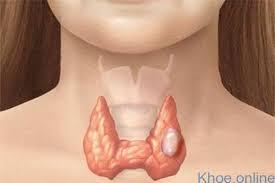 Điều trị cường giáp như thế nào