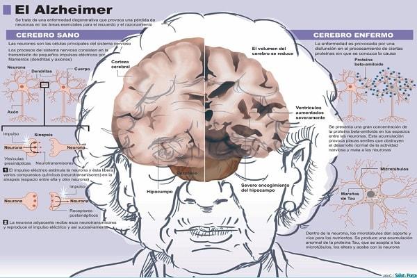 Điều trị hội chứng mất trí nhớ thường xuyên alzheimer như thế nào