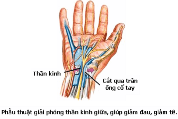 Điều trị hội chứng ống cổ tay như thế nào