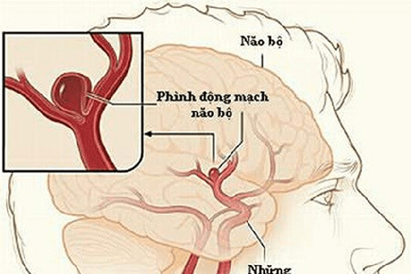 Điều trị vật lý cho bệnh nhân bị tai biến mạch máu não