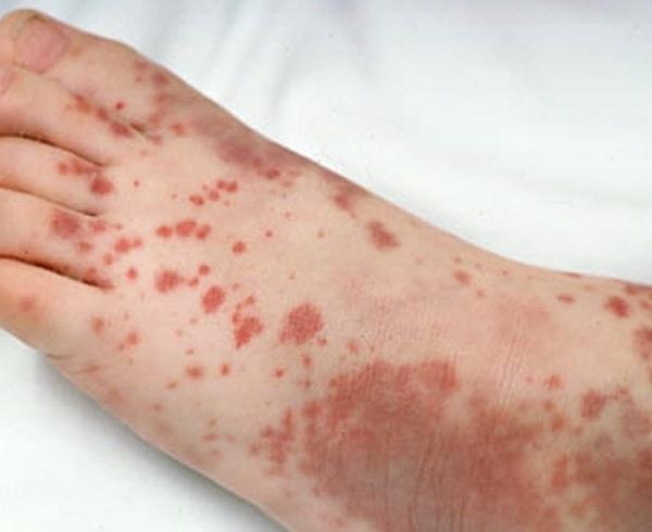 Đốm xuất huyết là dấu hiệu của bệnh gì?