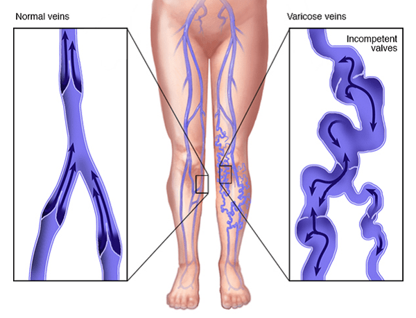 Tĩnh mạch suy giãn có liên quan đến các tình trạng khác như knock knee và flat foot hay không?
