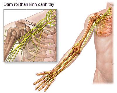 Co giật cơ cánh tay - Nguyên nhân và Cách phòng ngừa