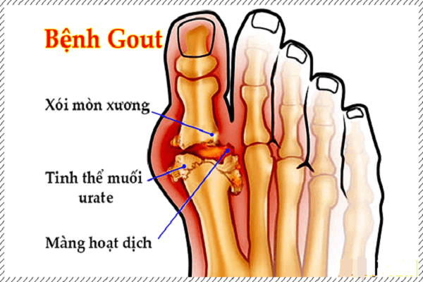 Gout