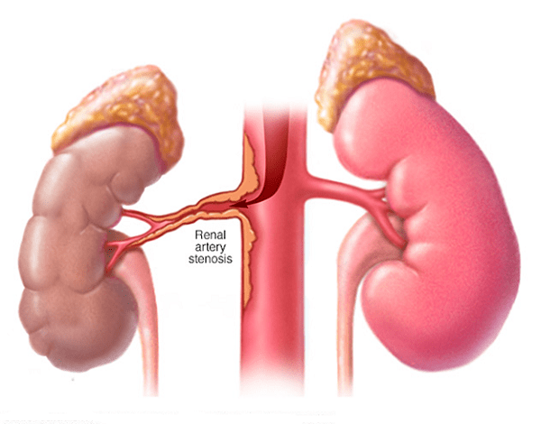 Hẹp động mạch thận
