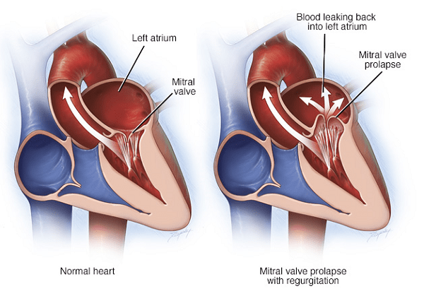 Có những loại hở van tim nào và chúng có những triệu chứng và dấu hiệu như thế nào?
