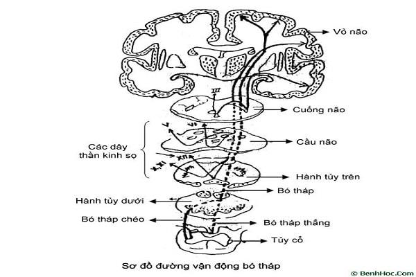 Hội chứng liệt nửa người