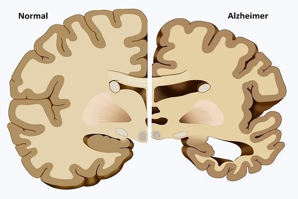 Alzheimer