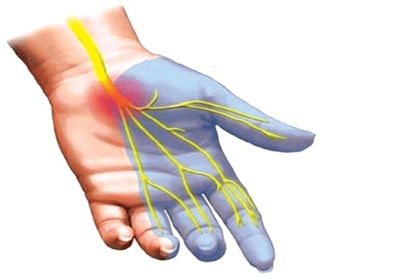 Ai có nguy cơ cao mắc hội chứng ống cổ tay?
