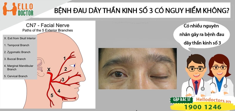 Chẩn Đoán Vấn Đề Liên Quan Đến Dây Thần Kinh Số 3